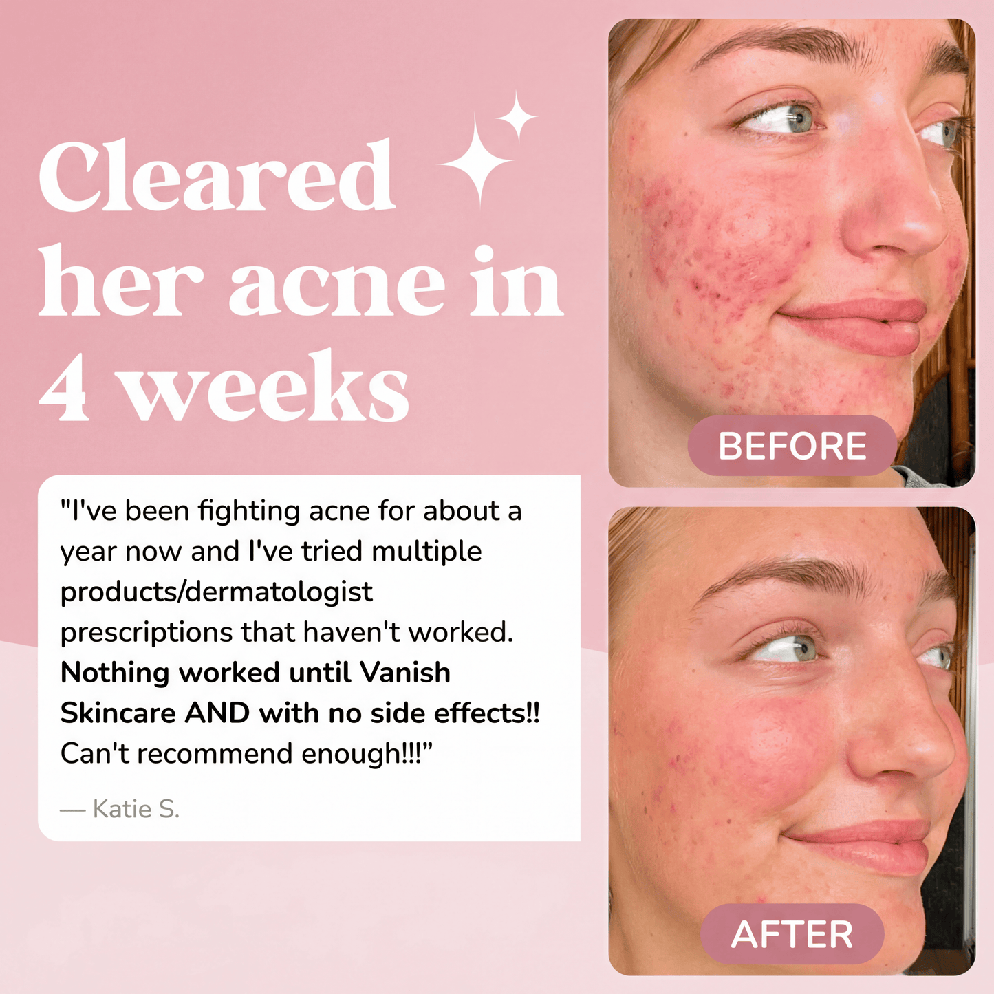 Acne Clearing & Skin Healing Regimen