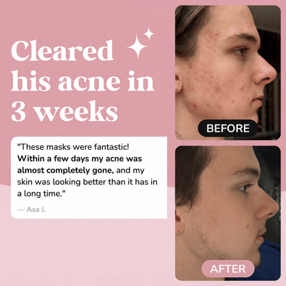 Acne Clearing & Skin Healing Regimen